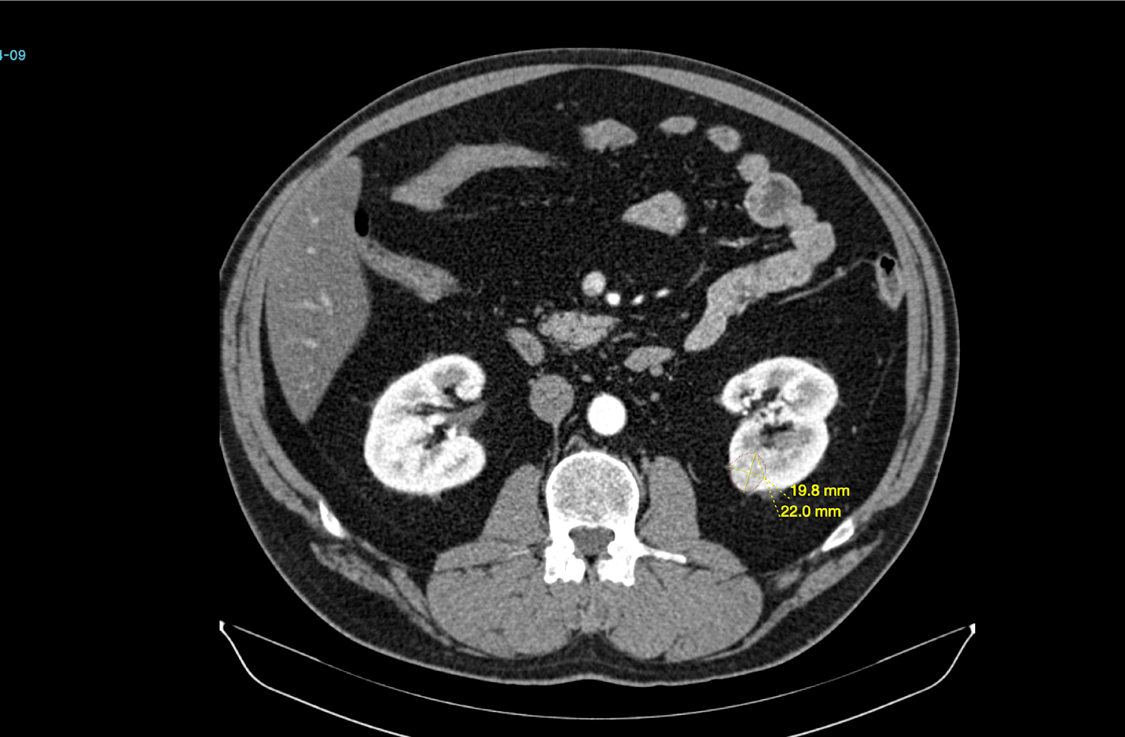 BM_Kidney_AI_product (3)