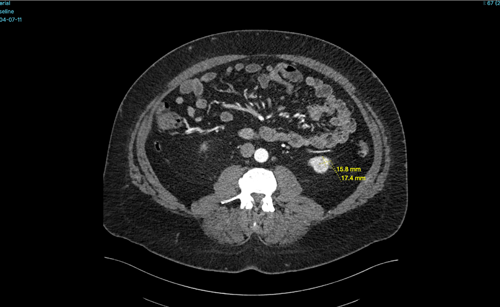 BM_Kidney_AI_product (4)